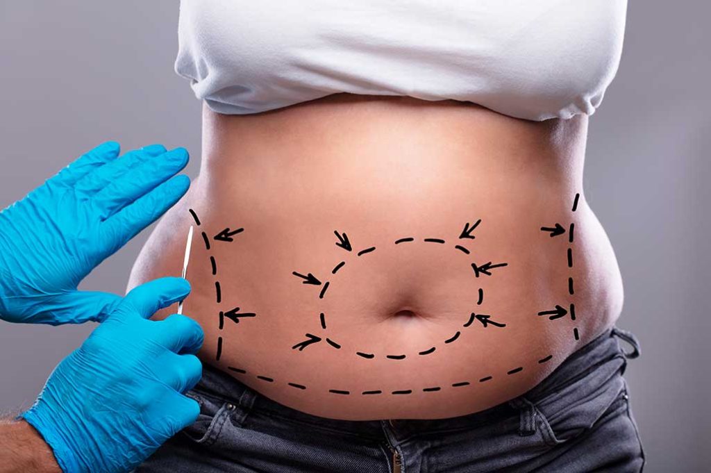 ABDOMONIPLASTÍA